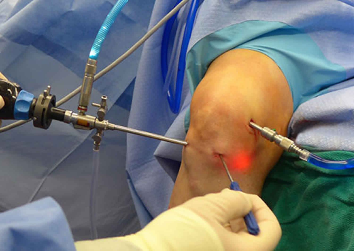 best-knee-arthroscopy-surgeon-doctor-in-gota-knee-arthroscopy-in-gota